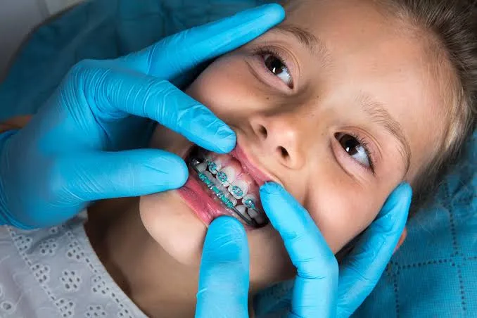 Orthodontics for Children: Simple Answers to Common Parent Questions
