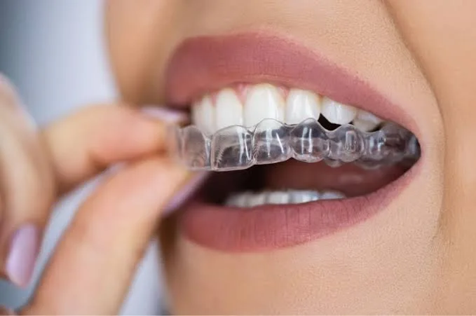 What is clear teeth aligners in Pakenham and why is it important?